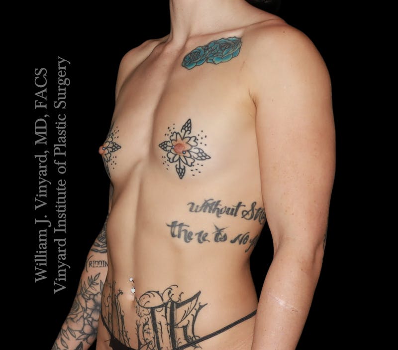 Breast Augmentation Before & After Gallery - Patient 386130 - Image 5