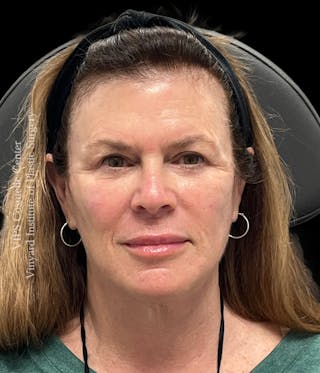 Lip Fillers Before & After Gallery - Patient 242061 - Image 2