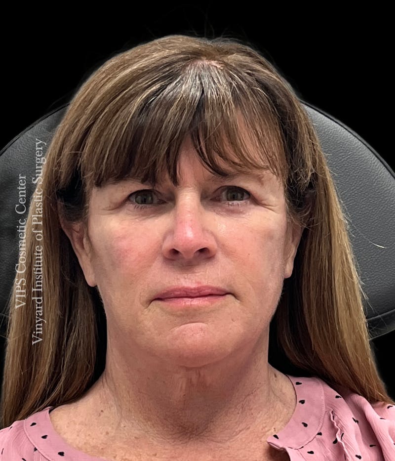 Lip Fillers Before & After Gallery - Patient 242061 - Image 1