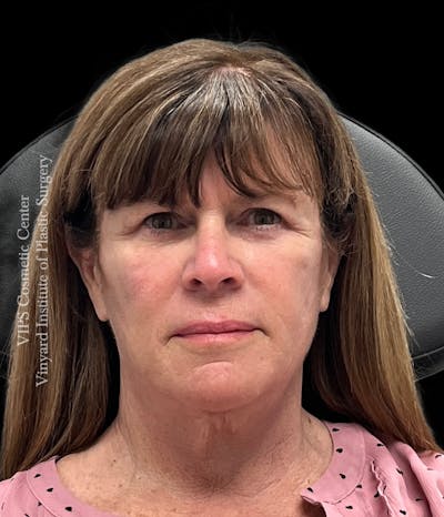 RF Microneedling Morpheus 8 Before & After Gallery - Patient 174508 - Image 1