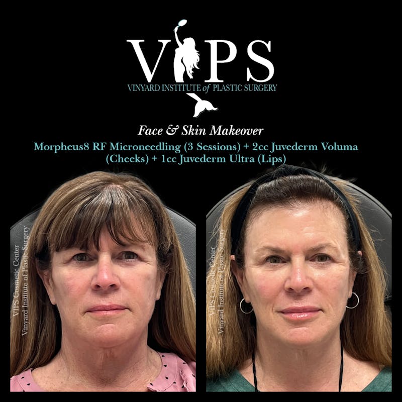 Lip Fillers Before & After Gallery - Patient 242061 - Image 7