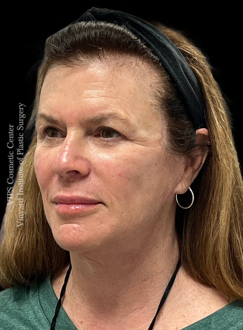 Lip Fillers Before & After Gallery - Patient 242061 - Image 4