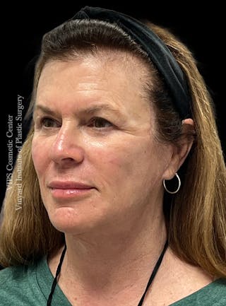 Lip Fillers Before & After Gallery - Patient 242061 - Image 4