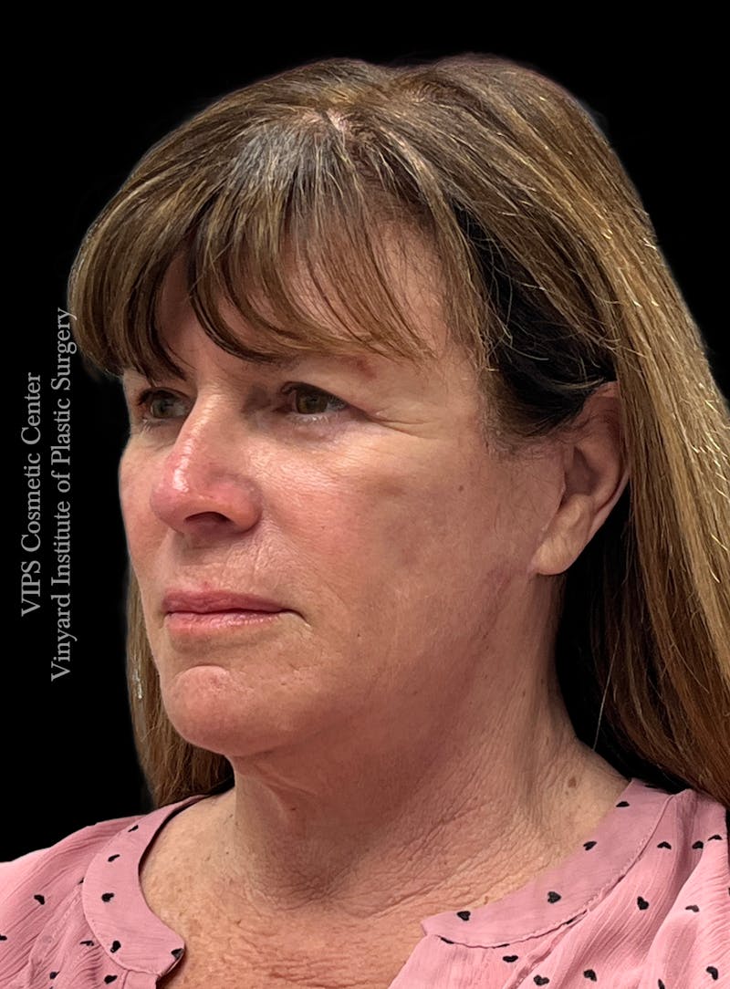 Lip Fillers Before & After Gallery - Patient 242061 - Image 3