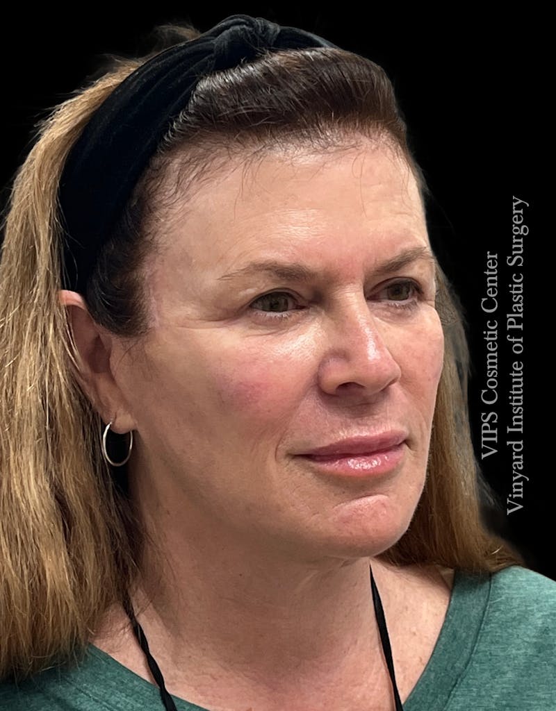 Lip Fillers Before & After Gallery - Patient 242061 - Image 6