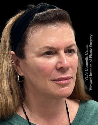 Lip Fillers Before & After Gallery - Patient 242061 - Image 6