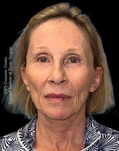 RF Microneedling Morpheus 8 Before & After Gallery - Patient 107730 - Image 1