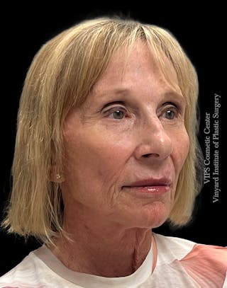 Skin Pigment Removal Before & After Gallery - Patient 413387 - Image 4