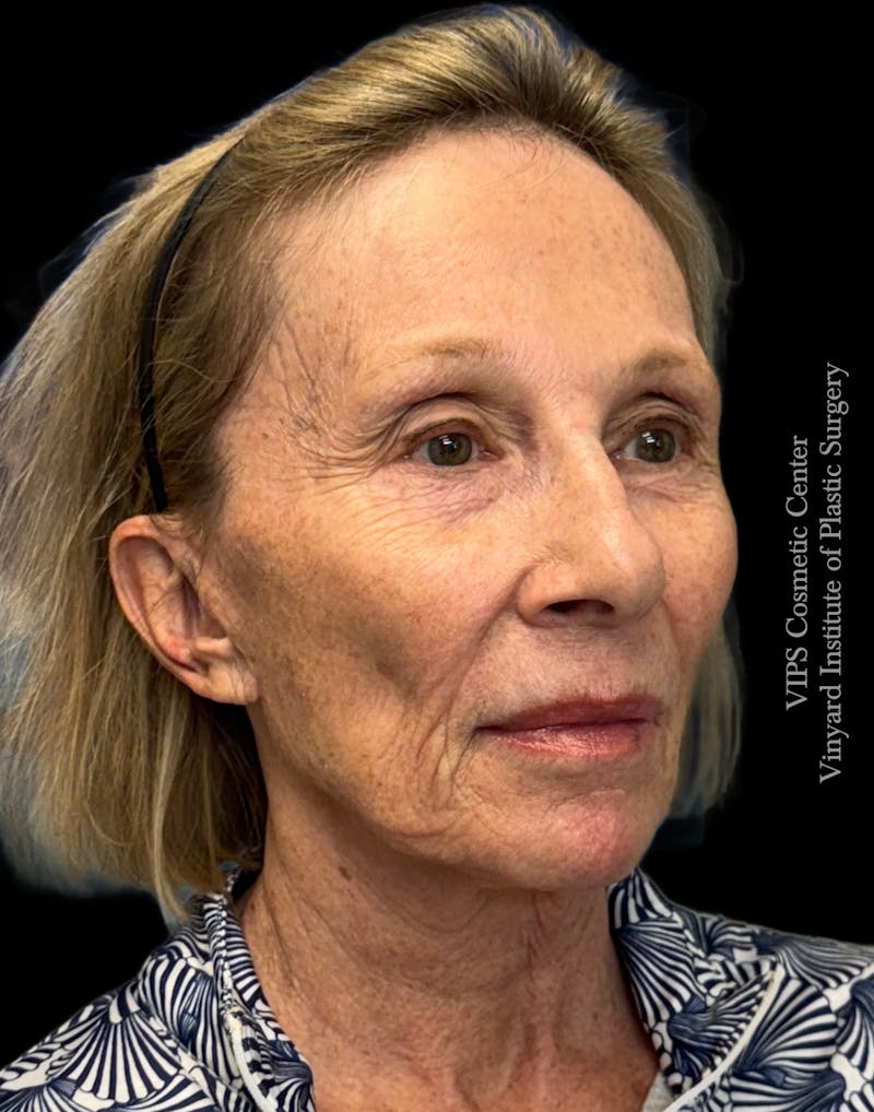 Skin Pigment Removal Before & After Gallery - Patient 413387 - Image 3