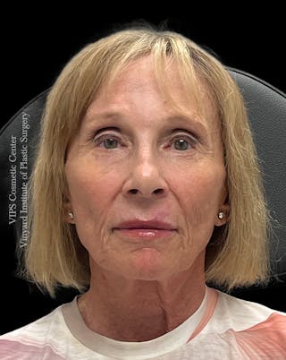 Skin Pigment Removal Before & After Gallery - Patient 413387 - Image 2