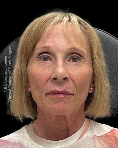 Skin Pigment Removal Before & After Gallery - Patient 413387 - Image 2