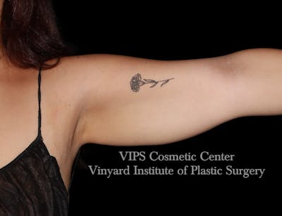 Coolsculpting ELITE Before & After Gallery - Patient 163012 - Image 2