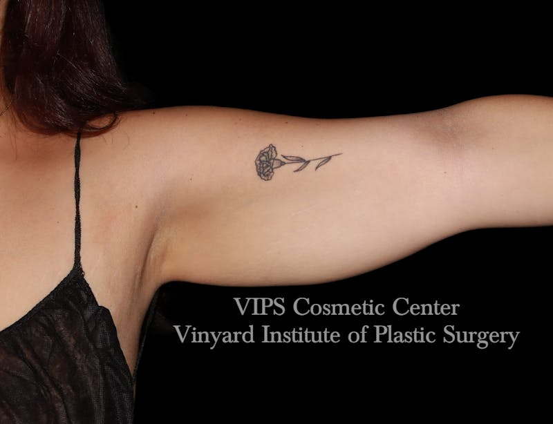 Coolsculpting ELITE Before & After Gallery - Patient 163012 - Image 2