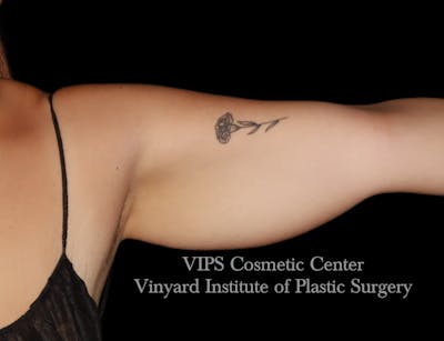 Coolsculpting ELITE Before & After Gallery - Patient 163012 - Image 1