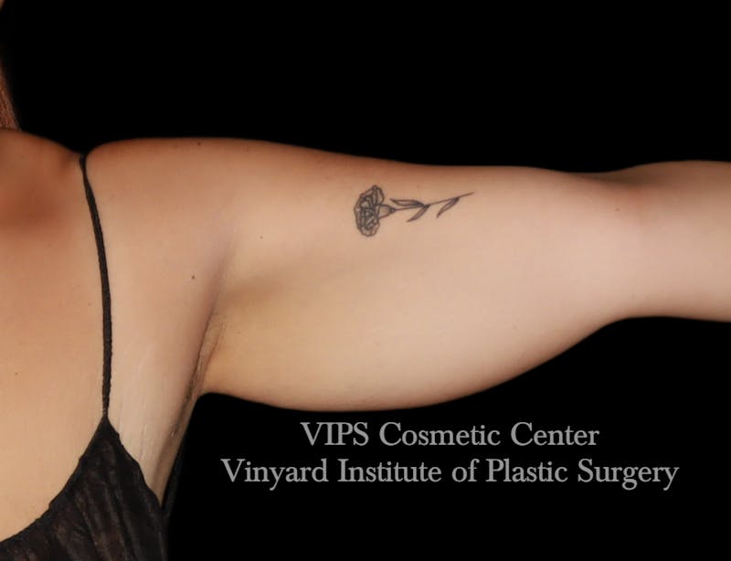 Coolsculpting ELITE Before & After Gallery - Patient 163012 - Image 1