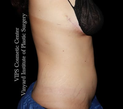 Coolsculpting ELITE Before & After Gallery - Patient 347557 - Image 2