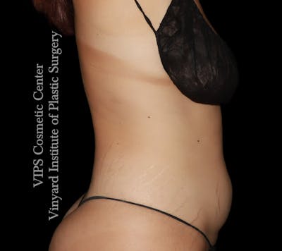 Coolsculpting ELITE Before & After Gallery - Patient 347557 - Image 1