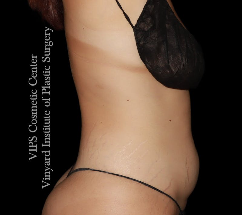 Coolsculpting ELITE Before & After Gallery - Patient 347557 - Image 1