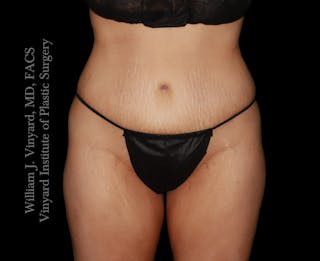Tummy Tuck Before & After Gallery - Patient 172446 - Image 2