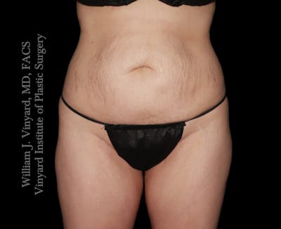 Tummy Tuck Before & After Gallery - Patient 172446 - Image 1