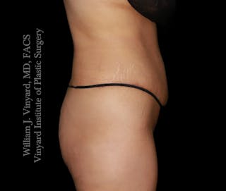 Tummy Tuck Before & After Gallery - Patient 172446 - Image 4