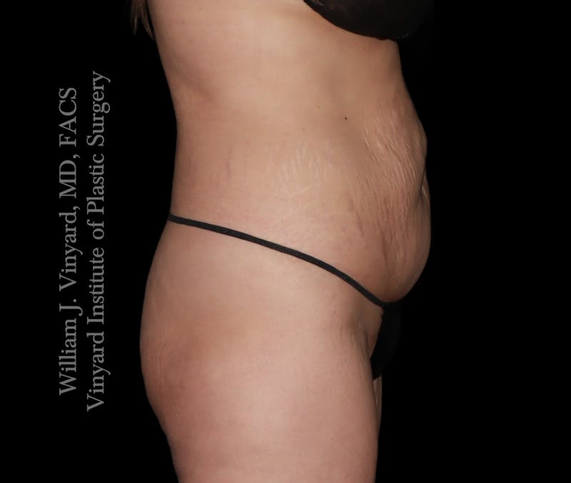 Tummy Tuck Before & After Gallery - Patient 172446 - Image 3