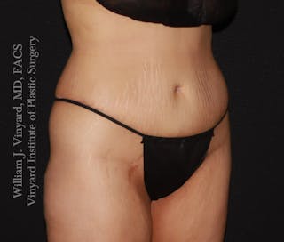 Tummy Tuck Before & After Gallery - Patient 172446 - Image 6