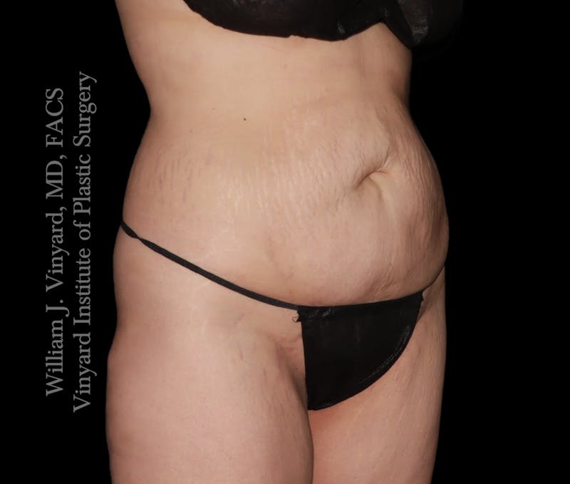 Tummy Tuck Before & After Gallery - Patient 172446 - Image 5