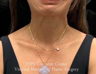 BOTOX® Before & After Gallery - Patient 428353 - Image 6