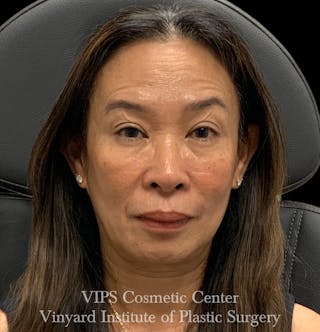 BOTOX® Before & After Gallery - Patient 428353 - Image 4