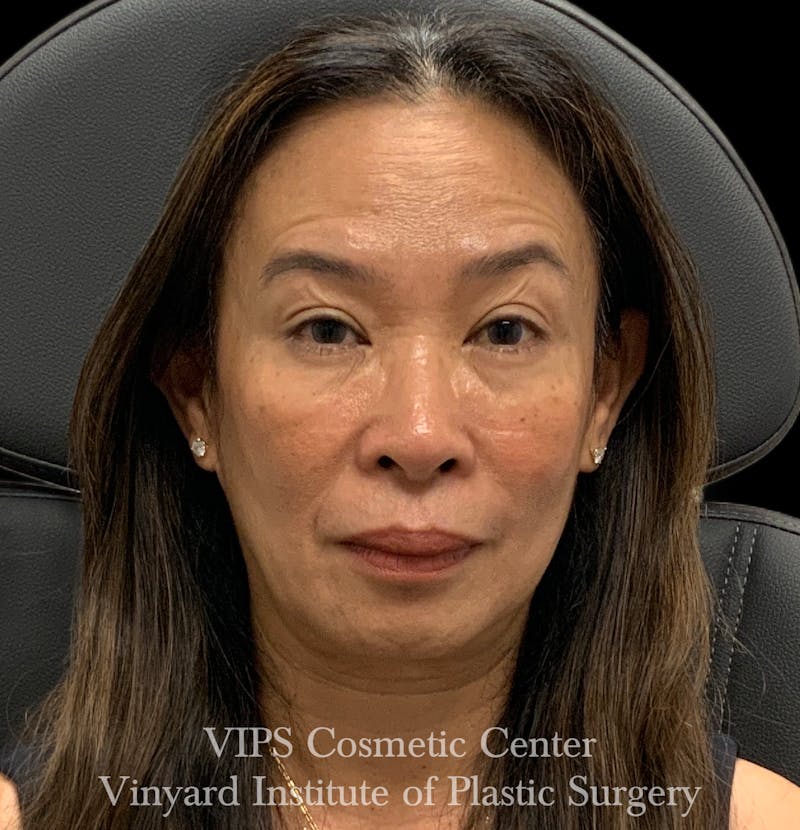 BOTOX® Before & After Gallery - Patient 428353 - Image 4