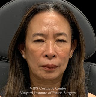 BOTOX® Before & After Gallery - Patient 428353 - Image 2