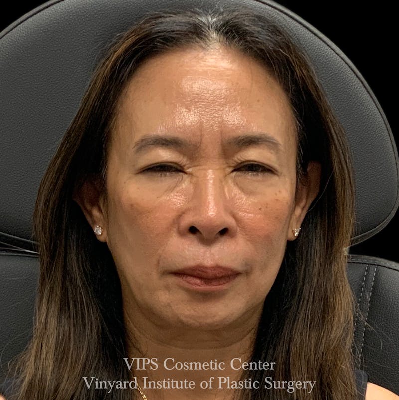 BOTOX® Before & After Gallery - Patient 428353 - Image 2