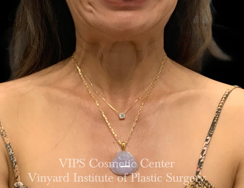 BOTOX® Before & After Gallery - Patient 428353 - Image 5