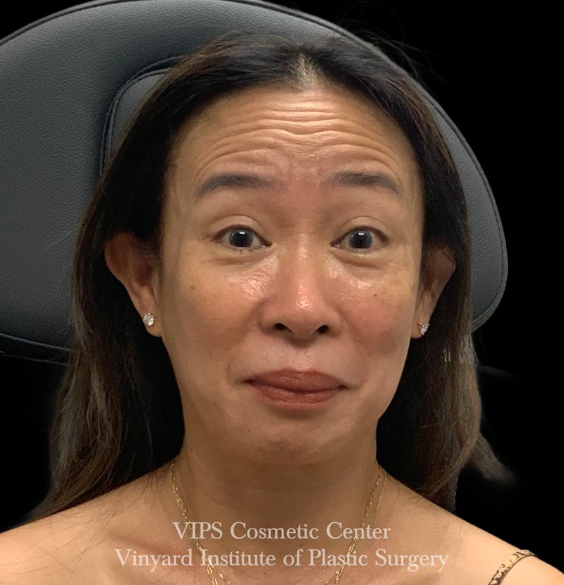 BOTOX® Before & After Gallery - Patient 428353 - Image 3