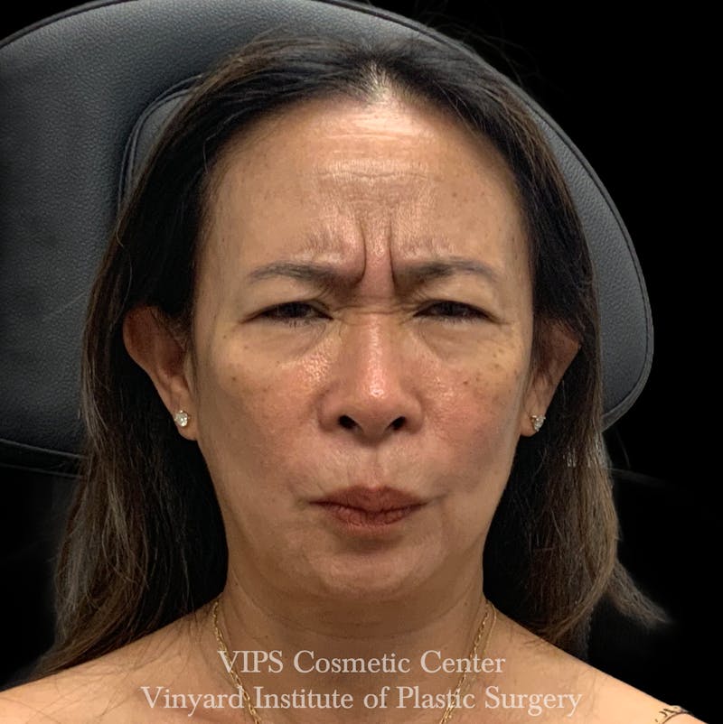 BOTOX® Before & After Gallery - Patient 428353 - Image 1
