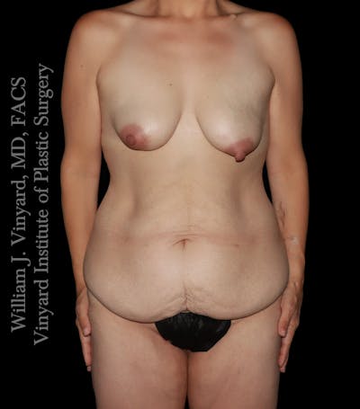 Mommy Makeover Before & After Gallery - Patient 130749 - Image 1