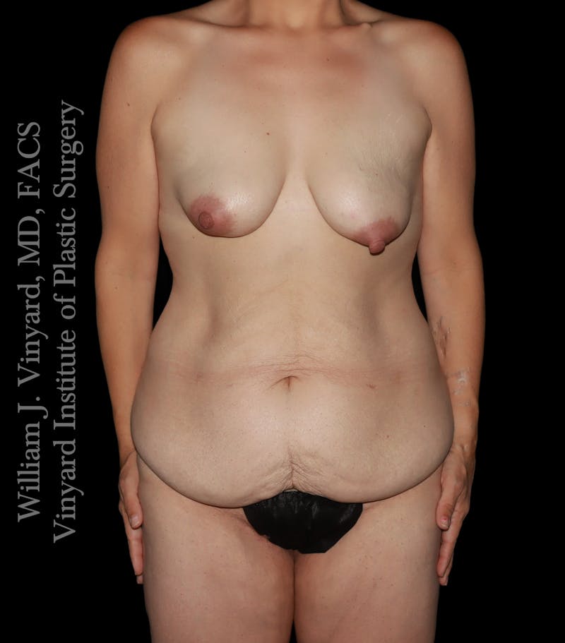 Mommy Makeover Before & After Gallery - Patient 130749 - Image 1