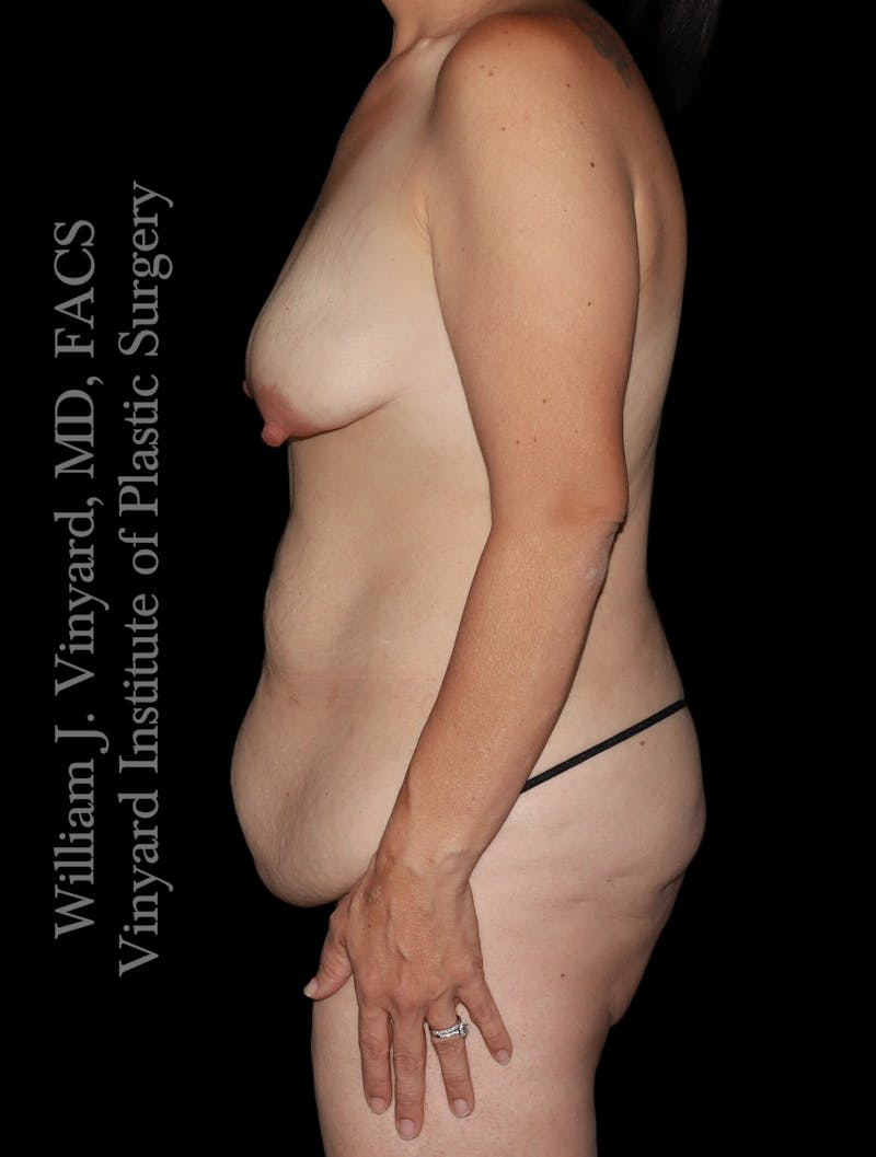 Mommy Makeover Before & After Gallery - Patient 130749 - Image 5