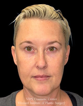 ELLUMINATE WITH IPL Before & After Gallery - Patient 260852 - Image 2