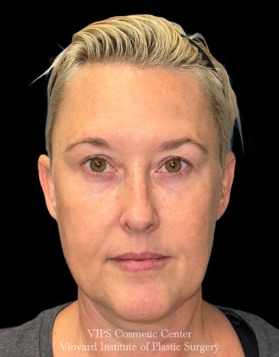 Elluminate Advanced Photofacial w/IPL Before & After Gallery - Patient 260852 - Image 2