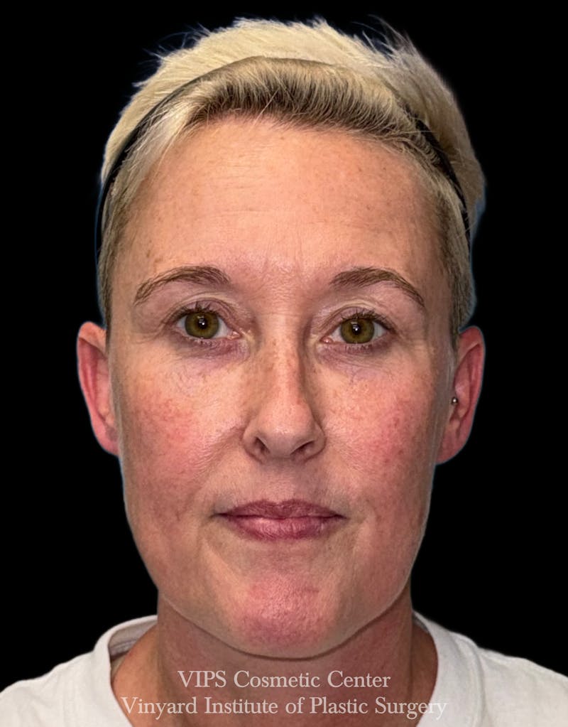 ELLUMINATE WITH IPL Before & After Gallery - Patient 260852 - Image 1