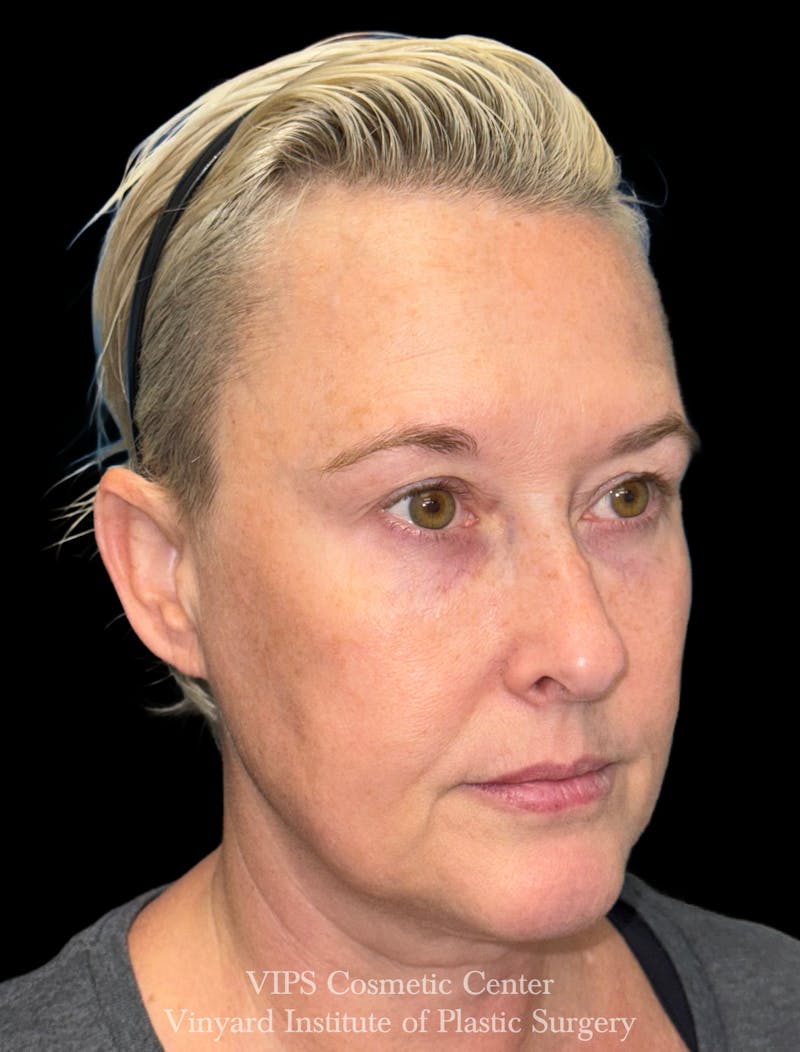 ELLUMINATE WITH IPL Before & After Gallery - Patient 260852 - Image 4