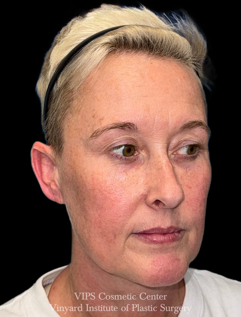 ELLUMINATE WITH IPL Before & After Gallery - Patient 260852 - Image 3