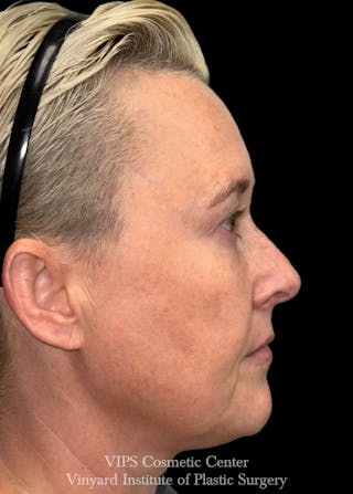ELLUMINATE WITH IPL Before & After Gallery - Patient 260852 - Image 6