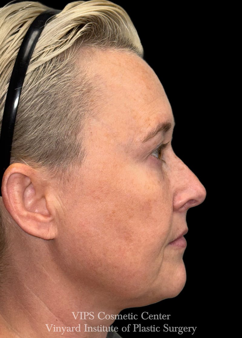 ELLUMINATE WITH IPL Before & After Gallery - Patient 260852 - Image 6