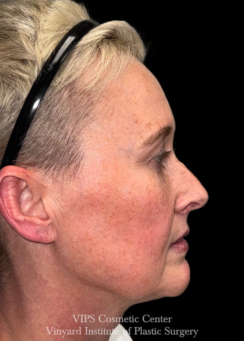 ELLUMINATE WITH IPL Before & After Gallery - Patient 260852 - Image 5