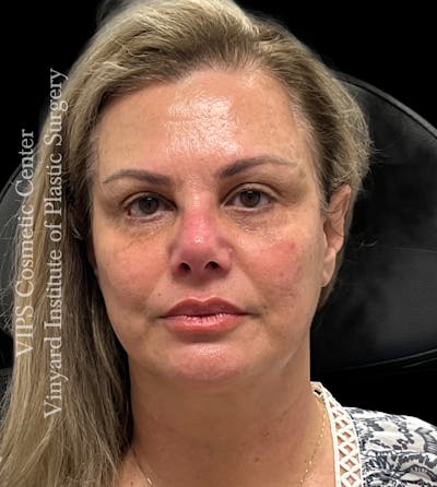 BOTOX® Before & After Gallery - Patient 155325 - Image 2