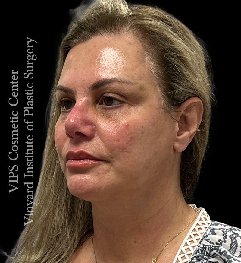 BOTOX® Before & After Gallery - Patient 155325 - Image 4