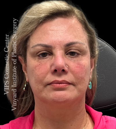 BOTOX® Before & After Gallery - Patient 155325 - Image 1